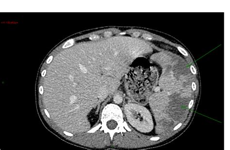 Figure 1 from The first INSPIRIS RESILIA Aortic Valve TM replacement (Edwards Lifesciences) in ...