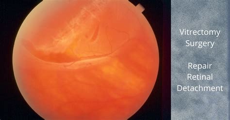 Retinal Detachment Archives - Nader Moinfar, MD, MPH, FACS, FASRS