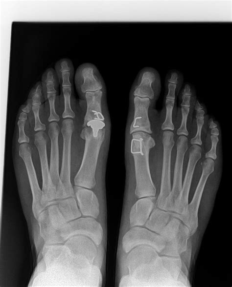 What Can Be Done For A Failed Joint Replacement In A Big Toe?: Foot and ...