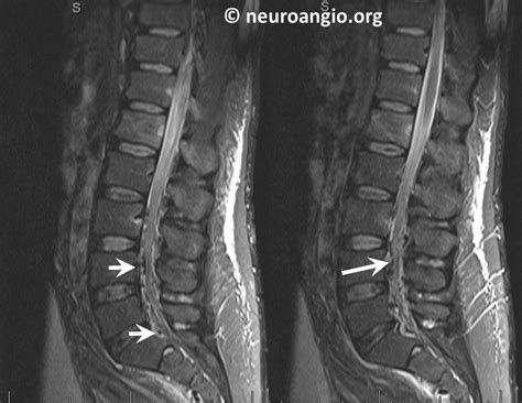 Archives Batson Venous Plexus | neuroangio.org