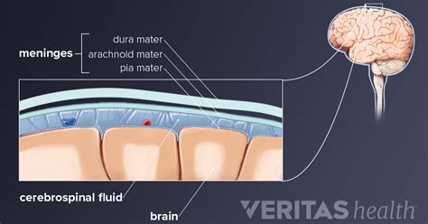 How Meningitis Causes Neck Pain and Stiffness