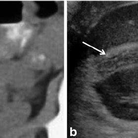 Normal appearance of the appendix on CT. The normal appendix ( arrow ...