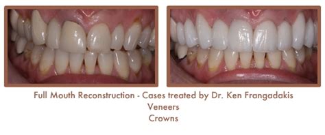 Before & After Full Reconstruction Gallery, Photo Gallery, Dentist ...