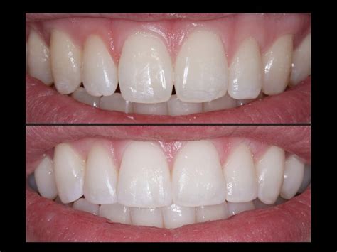 Composite Bonding – What is it and 3 Benefits Explained | W. Gregory Rose DDS, PA