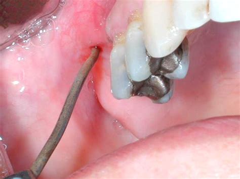 Endoscopic Surgical Treatment of Chronic Maxillary Sinusitis of Dental Origin - Journal of Oral ...