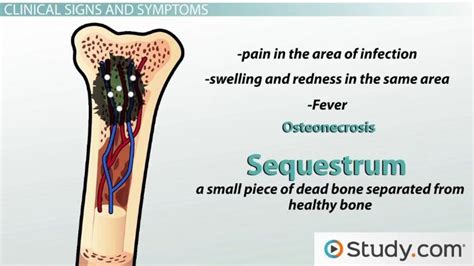 Osteomyelitis treatment in ayurveda