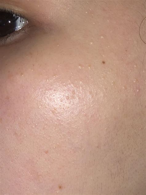 [Skin Concern] Bumpy skin texture - are these CCs? : r/SkincareAddiction