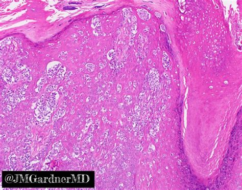 Acral Lentiginous Melanoma Histology