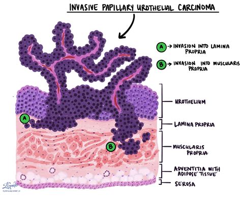 Papilláris uroteliális karcinóma | MyPathologyReport.ca