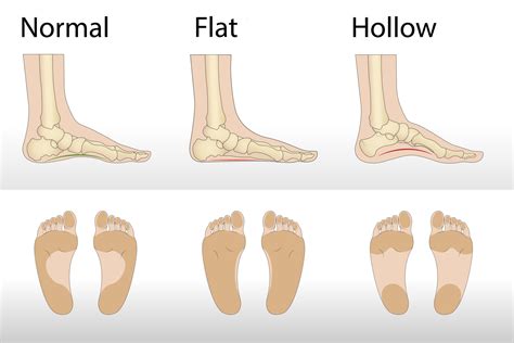 Foot deformity types, medical disease infographics. Hollow, flat, and normal foot. 8302847 ...