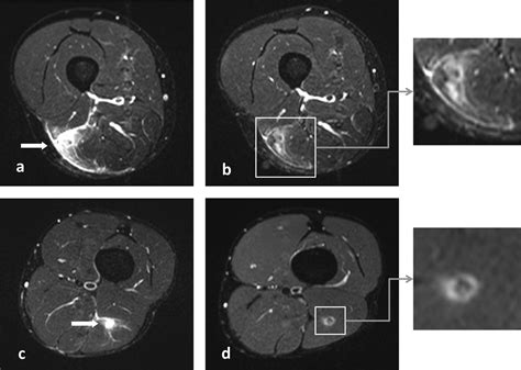 MRI observations at return to play of clinically recovered hamstring ...