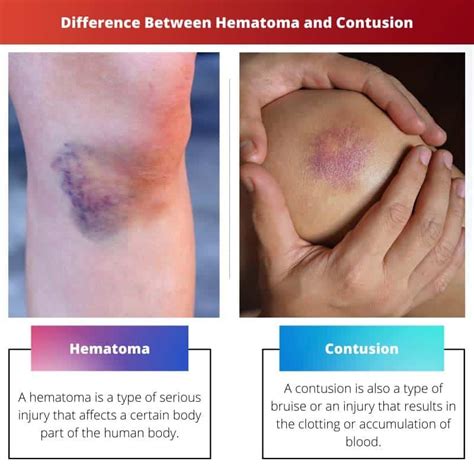 Hematoma vs Contusion: Difference and Comparison