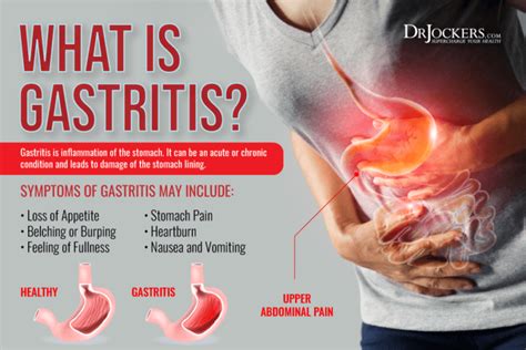 Gastritis: Symptoms, Causes, and Support Strategies - DrJockers.com