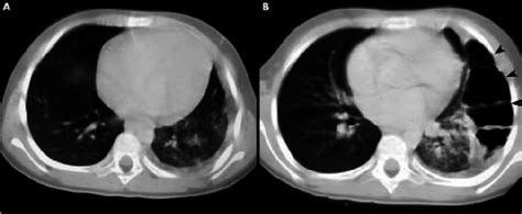 A 9.5 year old girl presented with periappendiceal abscess accompanied ...