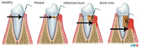 Gum Pockets: Causes and Cures – ToothShower