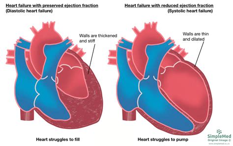 14. Heart Failure - SimpleMed - Learning Medicine, Simplified