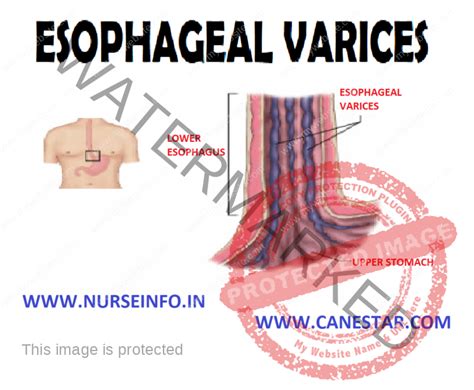 Esophageal Varices