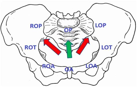 Occiput-Posterior Position (OP) - New