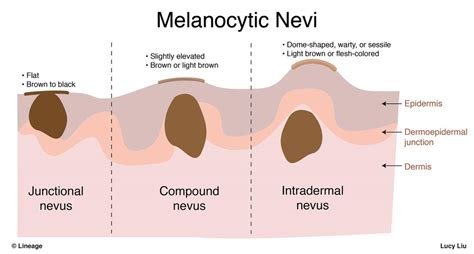 Nevi Diagram | Quizlet