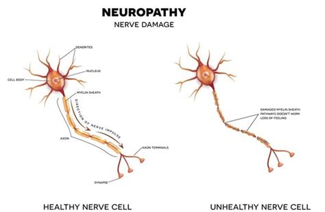 Small fiber neuropathy symptoms and causes – Artofit