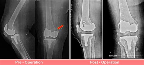 Periprosthetic Knee Fracture