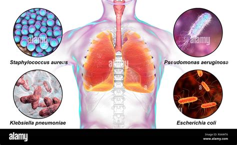 Bacteria that cause nosocomial pneumonia, illustration Stock Photo - Alamy