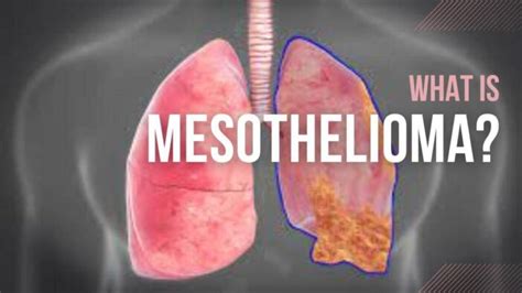 What Is Mesothelioma: Causes, Symptoms, And Treatment Options » 2024