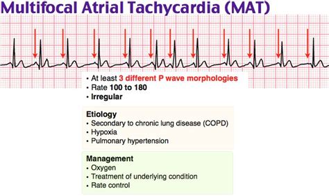 Rosh Review - MAT - multifocal atrial tachycardia - ECG - cardio ...