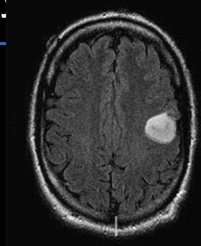 CNS tumors Flashcards | Quizlet