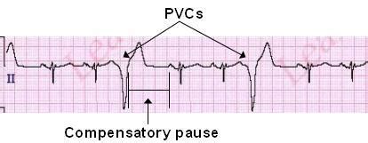 欠員 有益な 決定 pvc heart palpitations - okayama-kairo.jp