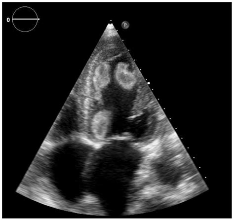 Clinics and Practice | Free Full-Text | Extensive Left Ventricular Thrombosis with Concomitant ...