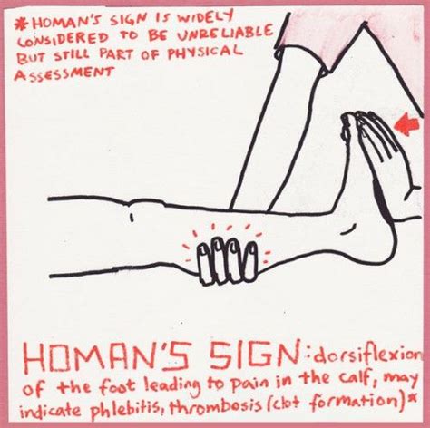 Homans sign for Thrombosis ... #DVT | Homans sign, Medical school ...