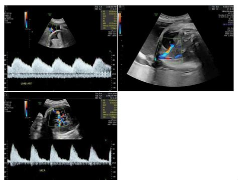 Antenatal ultrasound showing Fetal ascites, Echogenic bowel loops,... | Download Scientific Diagram