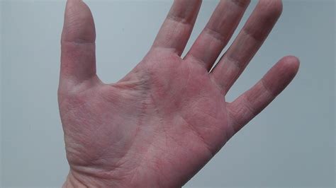 What causes itchy bumps on palms of hands