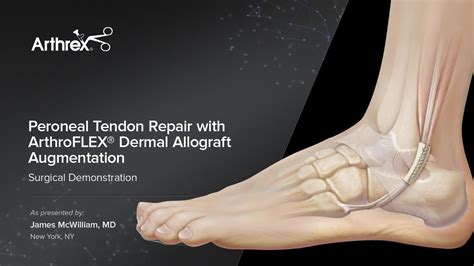 Arthrex - Peroneal Tendon Repair with ArthroFLEX® Dermal Allograft Augmentation