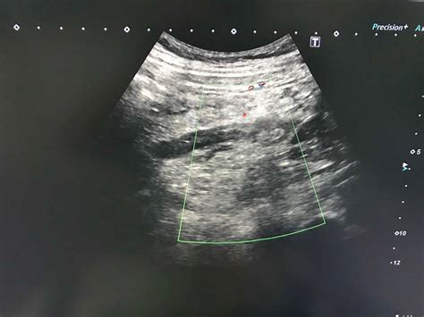 VIETNAMESE MEDIC ULTRASOUND: CASE 548: APPENDICITIS in PREGNANCY, Dr ...