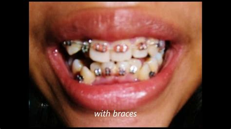 crowded teeth and braces #1 - YouTube