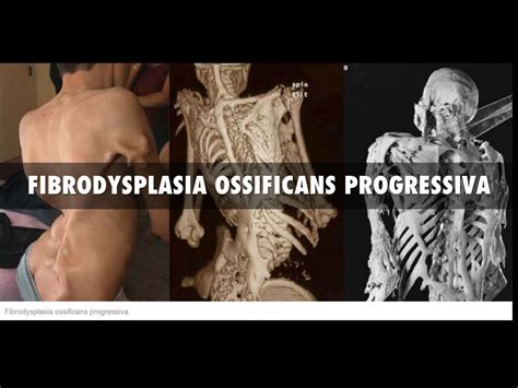 Fibrodysplasia ossificans progressiva by Jimmy Golden