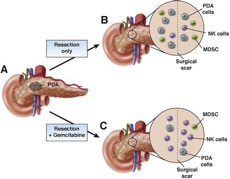 Gemcitabine Activates Natural Killer Cells to Attenuate Pancreatic ...