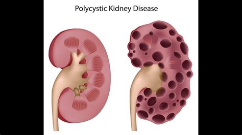 Polycystic Kidney Disease - (PEV) Patient Education Video - YouTube
