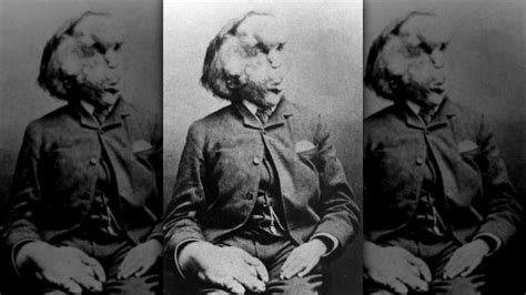 How The Elephant Man, Joseph Merrick, Really Died