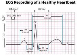 38 best images about NURSING QT INTERVAL IMPORTANT on Pinterest | Qrs ...