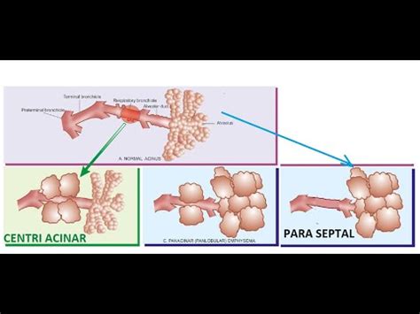 Pathology 459 c Emphysema Types CentriAcinar CentriLobular PanAcinar ...