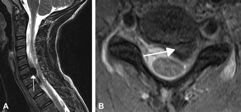 Herniated Nucleus Pulposus