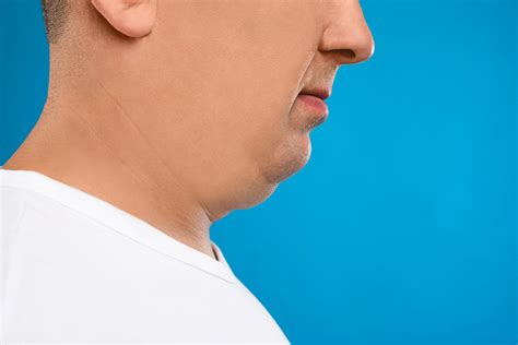 Kybella for Men - Cosmetic Dermatology Center