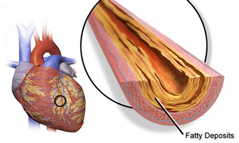 Blood test could accurately diagnose heart disease - Medical Design and Outsourcing