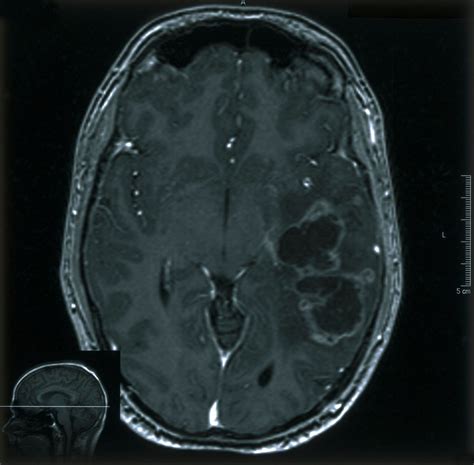 MRI scan; brain cancer (glioma) | Wellcome Collection