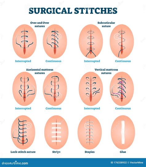 Method Of Surgical Suture For Wound Isolated On White Background Vector ...