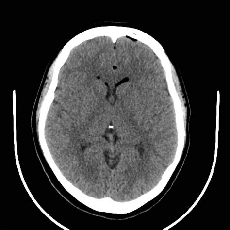 File:Traumatic pneumocranium, cribriform plate fracture and subarachnoid hemorrhage (Radiopaedia ...