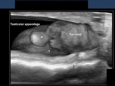 ON - RADIOLOGY: 3- D ultrasound image of appendix of testis